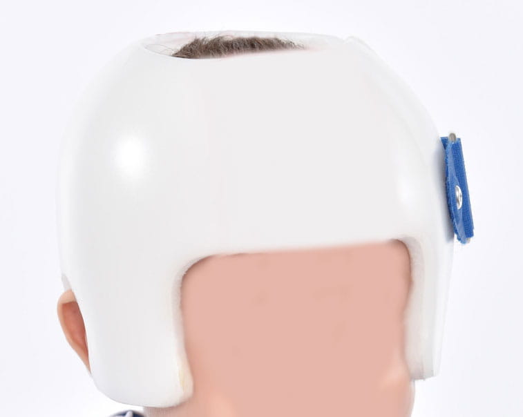 casco plagiocefalia posicional